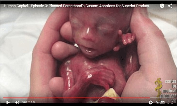 Fetal vivisection is SOP: a new Planned Parenthood video drops